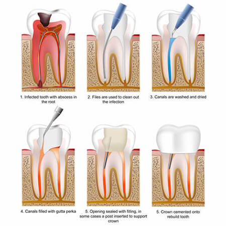 دوام دندان عصب کشی شده,راهنمای عصب کشی کردن دندان