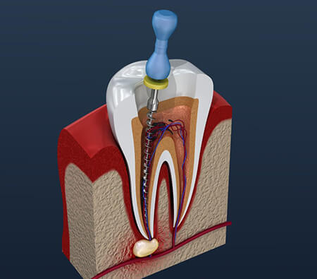 %name آشنایی با عمل کانال ریشه دندان یا عصب کشی