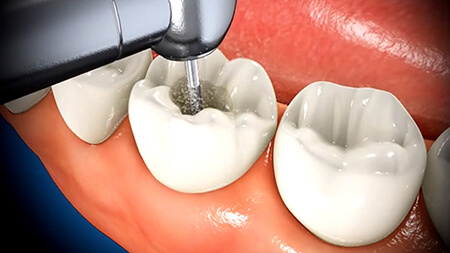 %name آشنایی با عمل کانال ریشه دندان یا عصب کشی