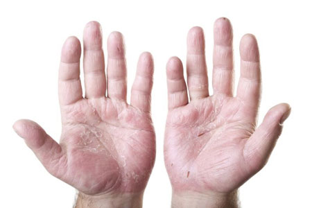 %name چگونه خشکی پوست دست را درمان کنیم؟