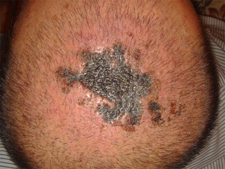 عفونت بعد از کاشت مو , درمان عفونت بعد از کاشت مو , علائم عفونت بعد از کاشت مو