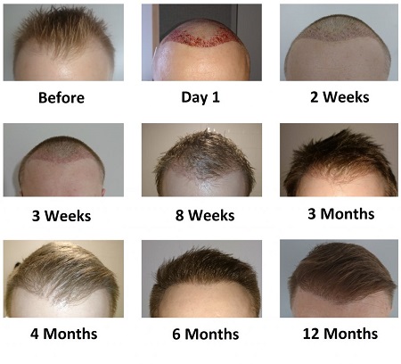 عکس عفونت بعد از کاشت مو , عفونت بعد از کاشت مو , درمان عفونت بعد از کاشت مو